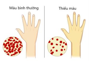 thieu-mau-nguyen-nhan-dau-hieu