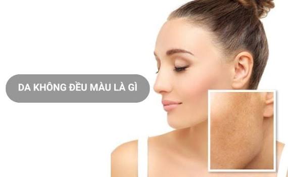 Chăm Sóc Da Có Nám Và Không Đều Màu