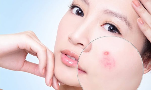 Chăm Sóc Da Mụn Đúng Cáchmoinh