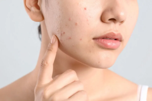 Chăm Sóc Da Mụn Đúng Cáchmoinh