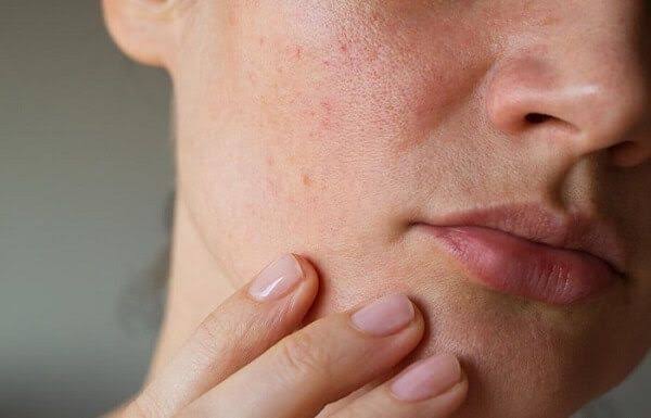 Da Xỉn Màu Nên Chăm Sóc Thế Nào